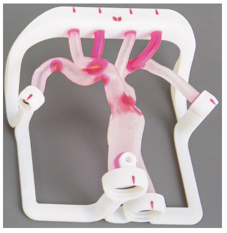 EVIAS Plus  - Type III Aortic Arch